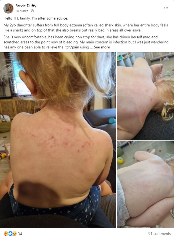 Eczema Eczema
