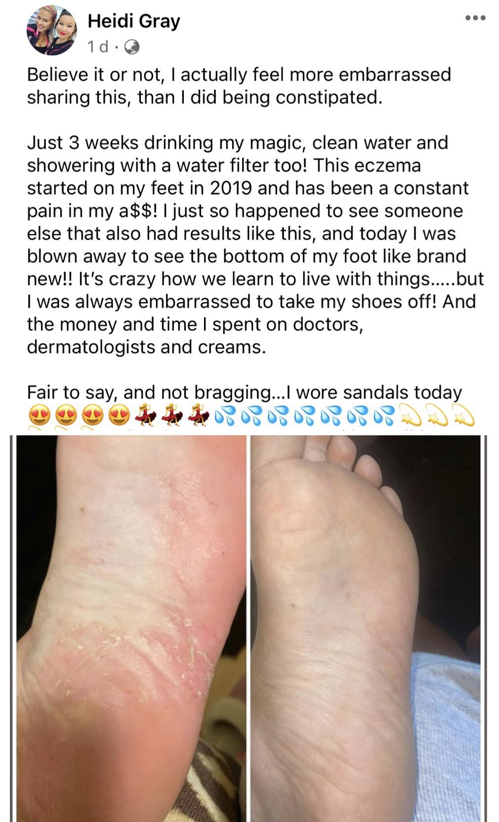 Eczema Eczema