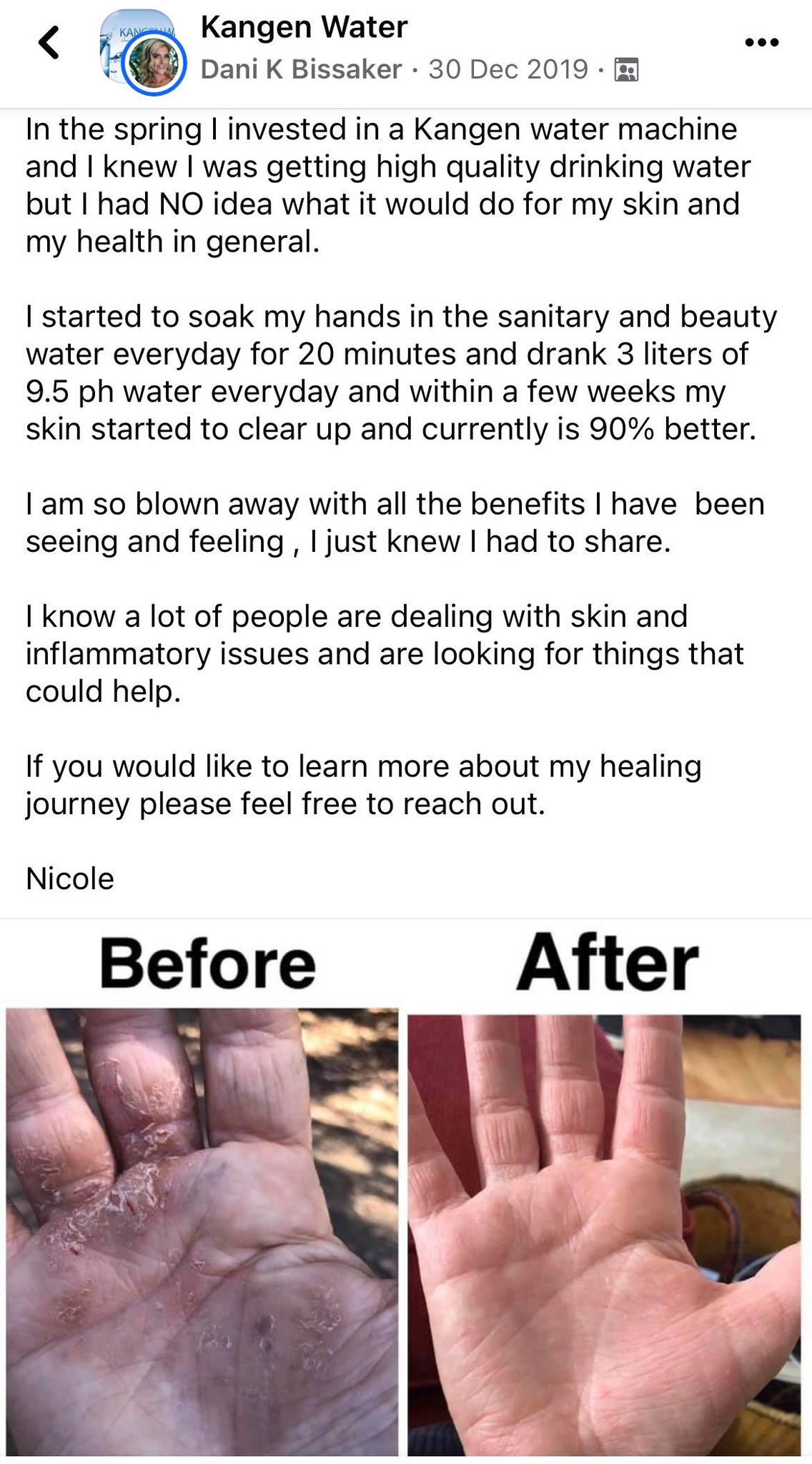 Eczema Eczema
